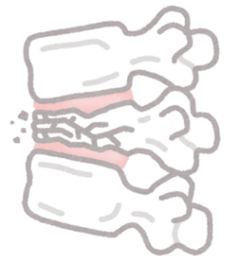 骨粗鬆症高齢者に多い骨折 4大骨折